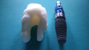 dental-implants